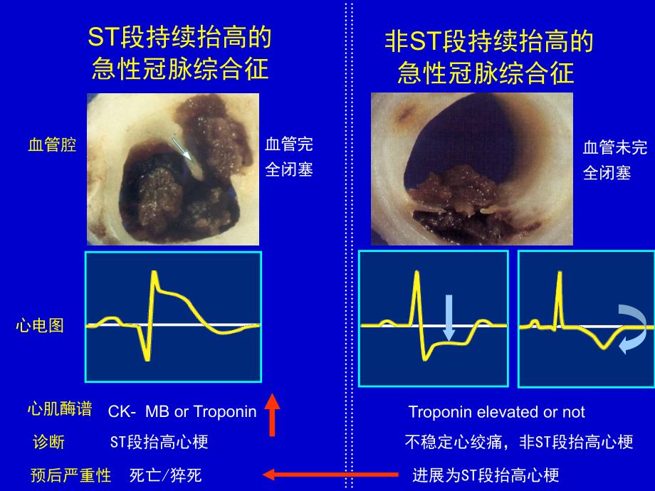 急性心肌梗死PPT课件.ppt_第3页