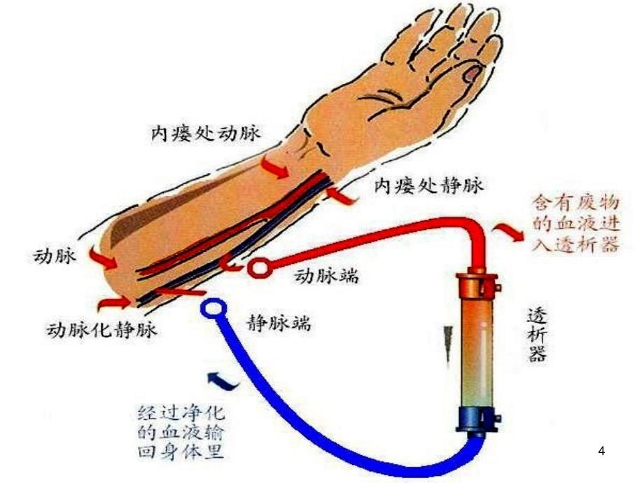 （优质课件）动静脉内瘘的护理与使用_第4页