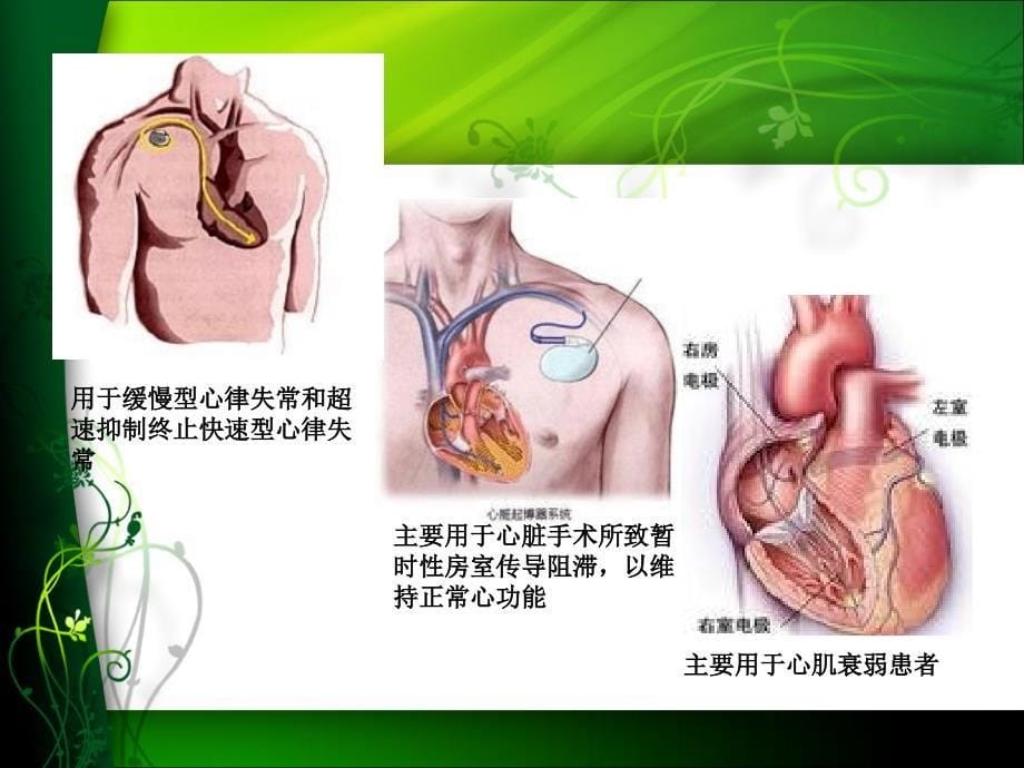 《临时起搏器的护理》PPT课件_第5页