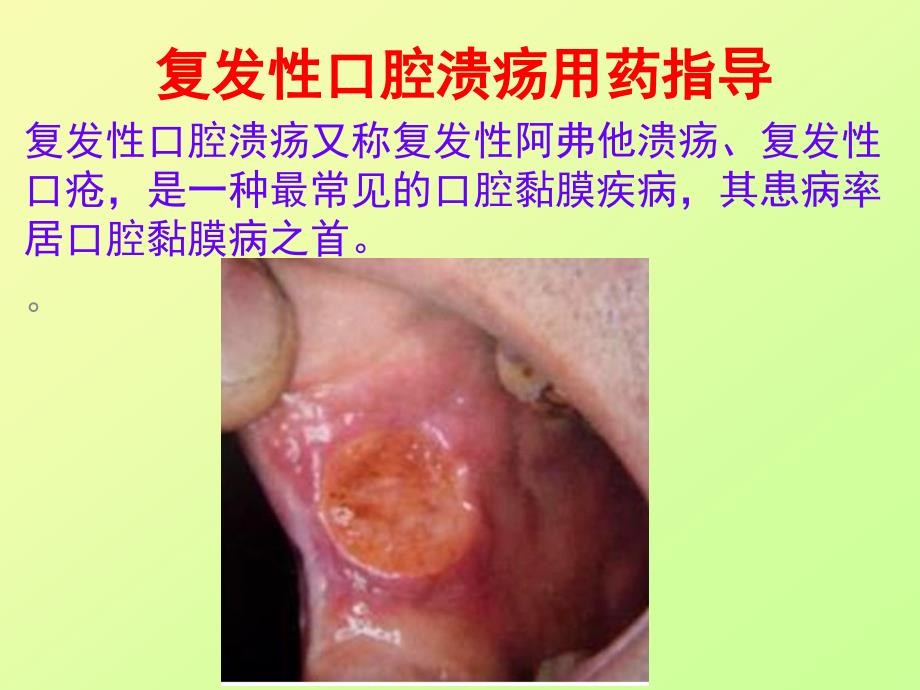 医学专题：复发性口腔溃疡用药指导_第1页