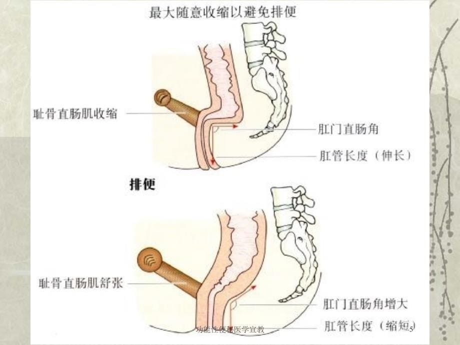 功能性便秘医学宣教培训课件_第5页