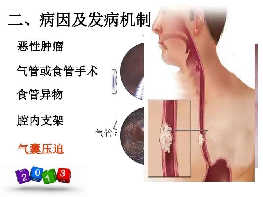 气管食管瘘.ppt课件_第5页