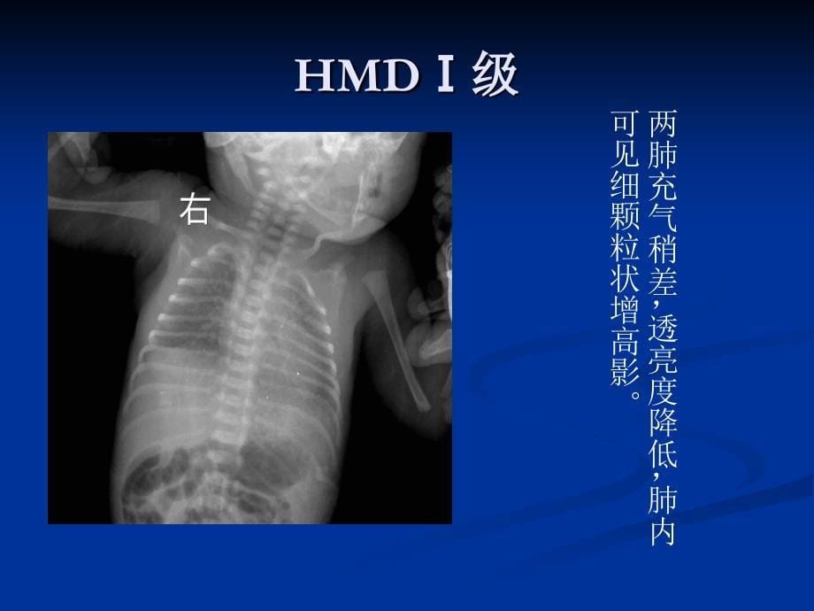 新生儿肺透明膜病的X线诊断课件_第5页