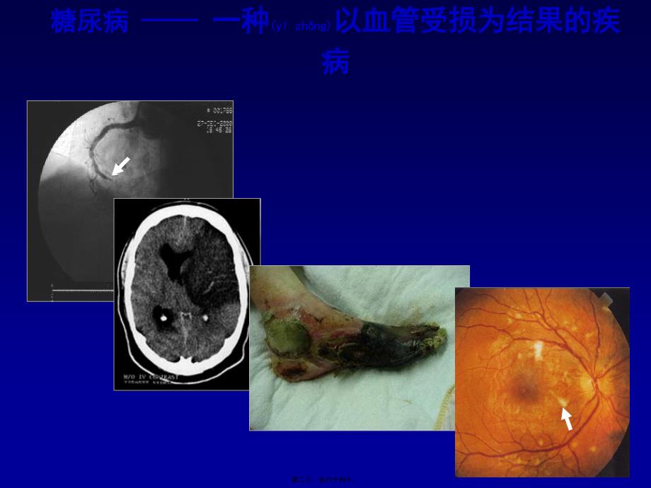 糖尿病大血管并发症课件_第2页