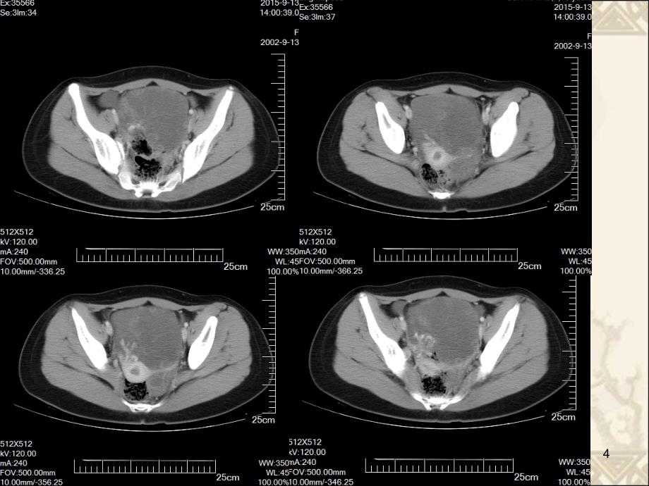 推荐精选卵巢囊肿蒂扭转CT_第4页