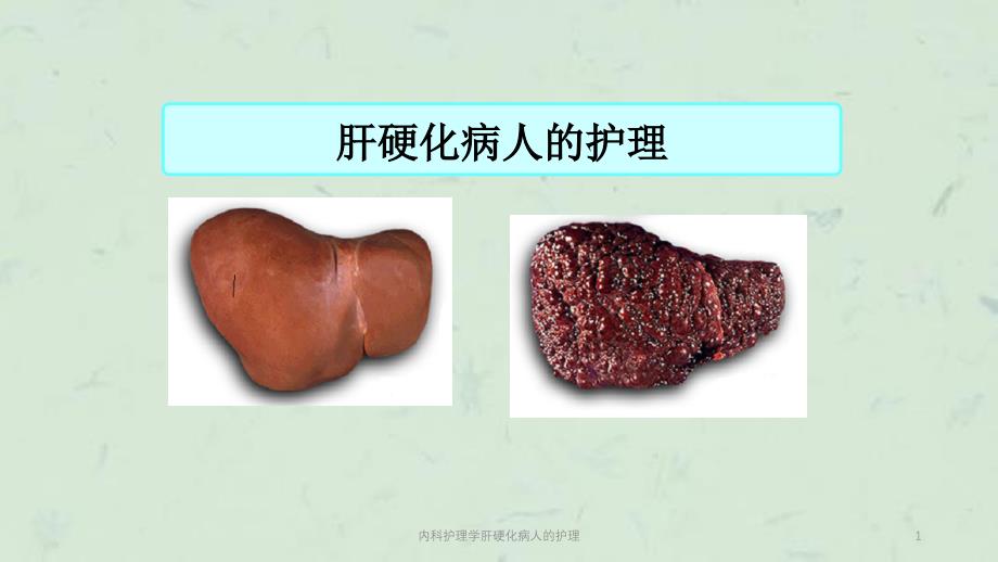 内科护理学肝硬化病人的护理课件_第1页