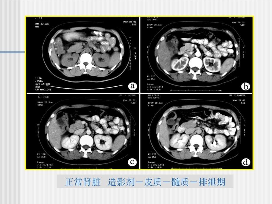 泌尿系统CT检查PPT课件_第5页