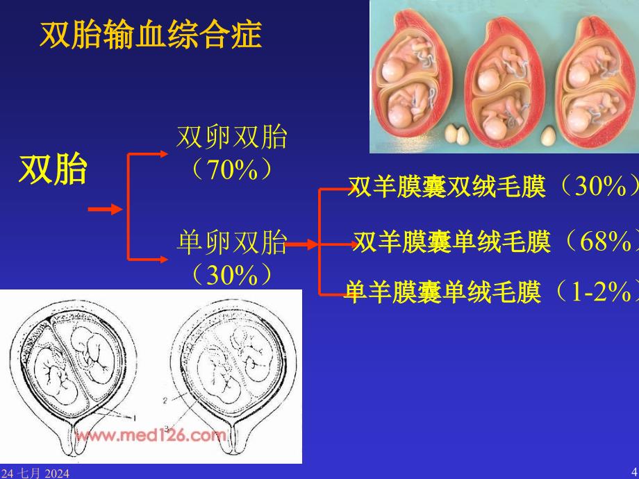 《双胎输血综合症》PPT课件.ppt_第4页