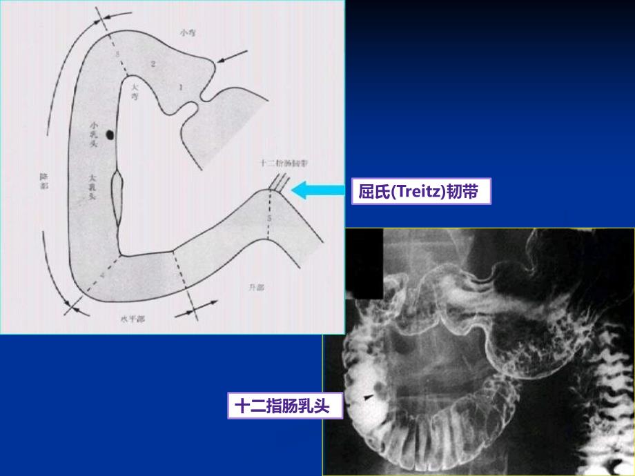 《医学影像学》实验课件（影像专业）：消化系统影像教学片三_第2页