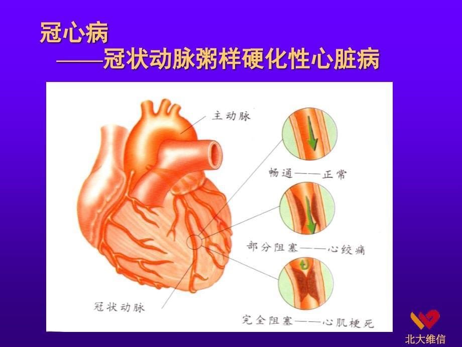 心脑血管病讲座课件_第5页