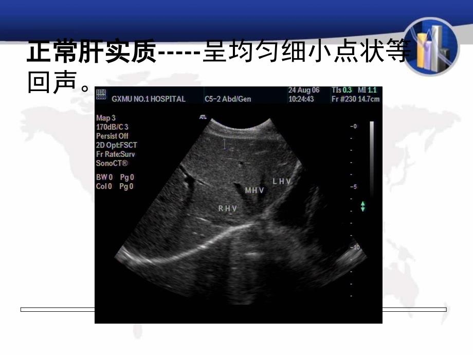 肝脏超声图片PPT课件_第4页