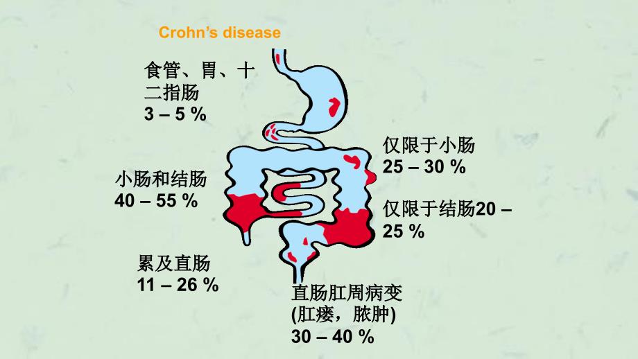 克罗恩病的护理资料课件_第3页