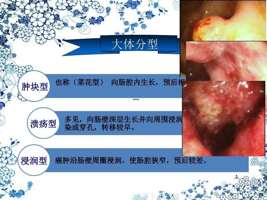 直肠癌及护理课件_第5页