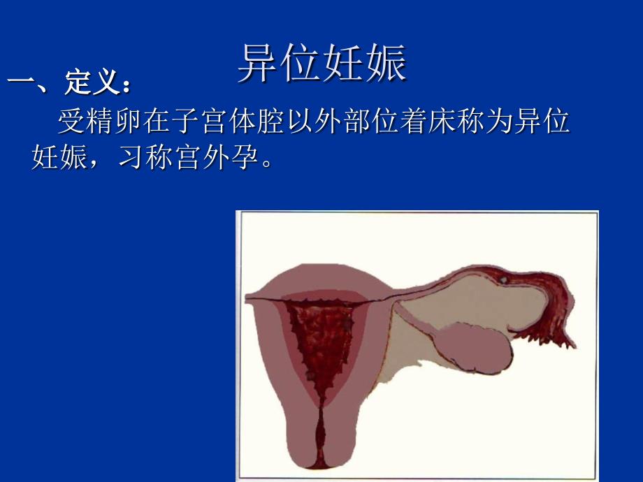 异位妊娠失血性休克的急救与护理.ppt_第3页