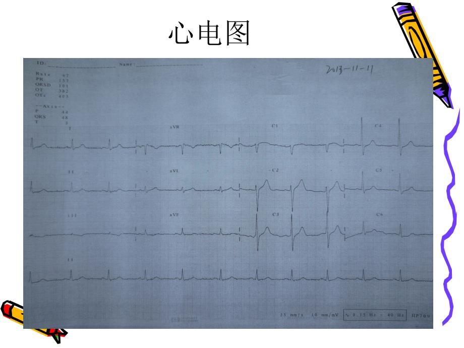 复杂冠脉介入并发症处理一例课件_第3页