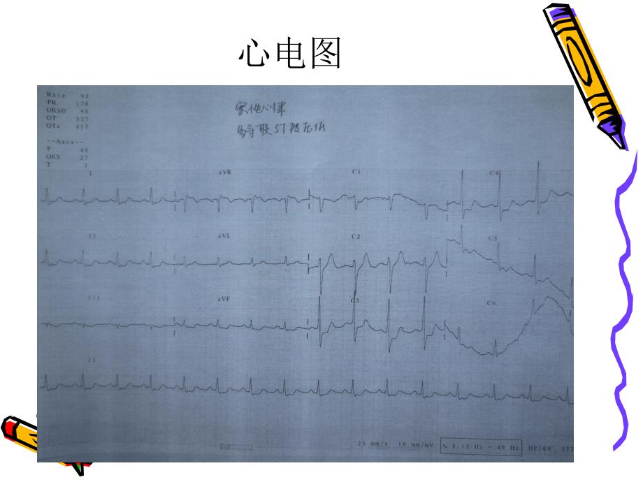 复杂冠脉介入并发症处理一例课件_第4页