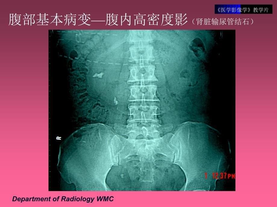 《医学影像学》实验课件（临床专业）：教学片4-消化系统1_第5页