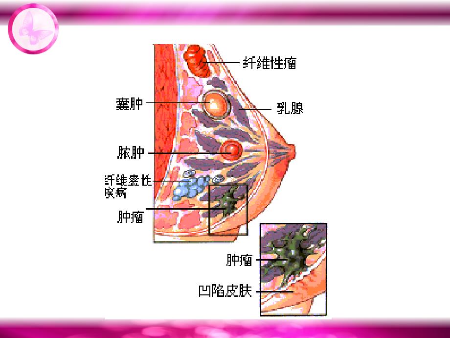 乳癌病人的护理知识ppt课件.ppt_第4页