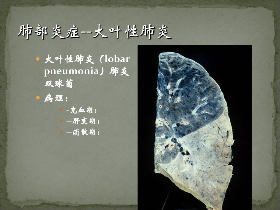 肺炎影像诊断.ppt_第4页