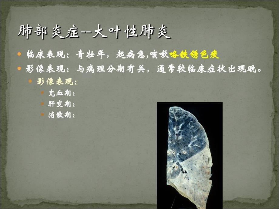 肺炎影像诊断.ppt_第5页