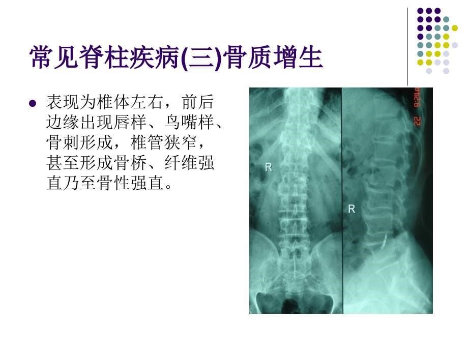 常见脊柱疾病_第5页