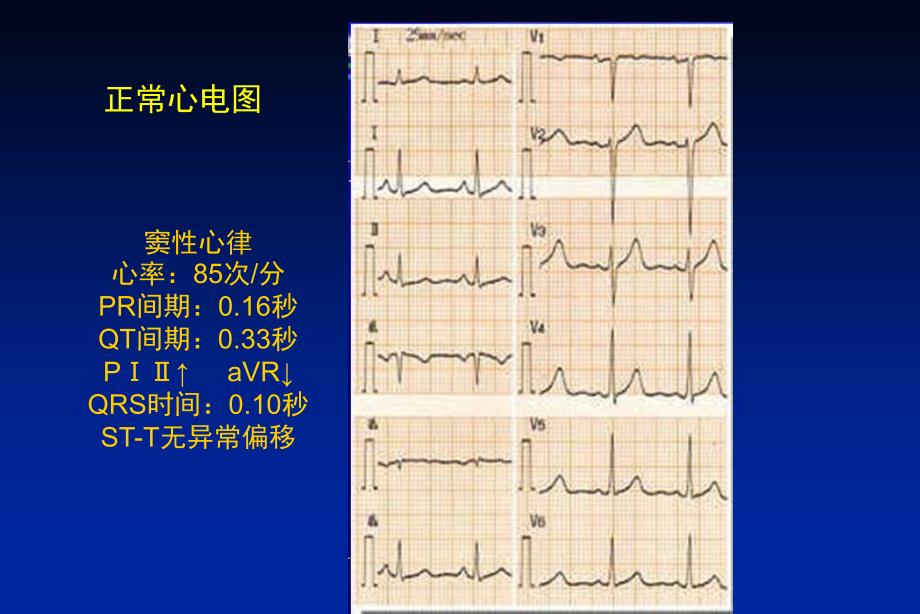 最新心律失常-11ppt课件_第2页