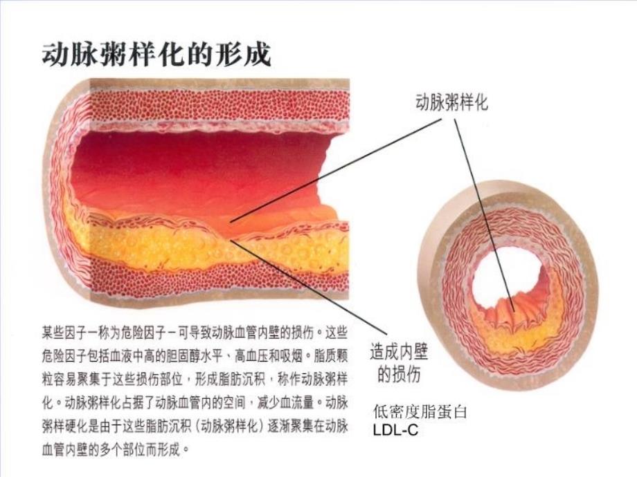 最新如何积极预防心脑血管疾病ppt课件_第4页