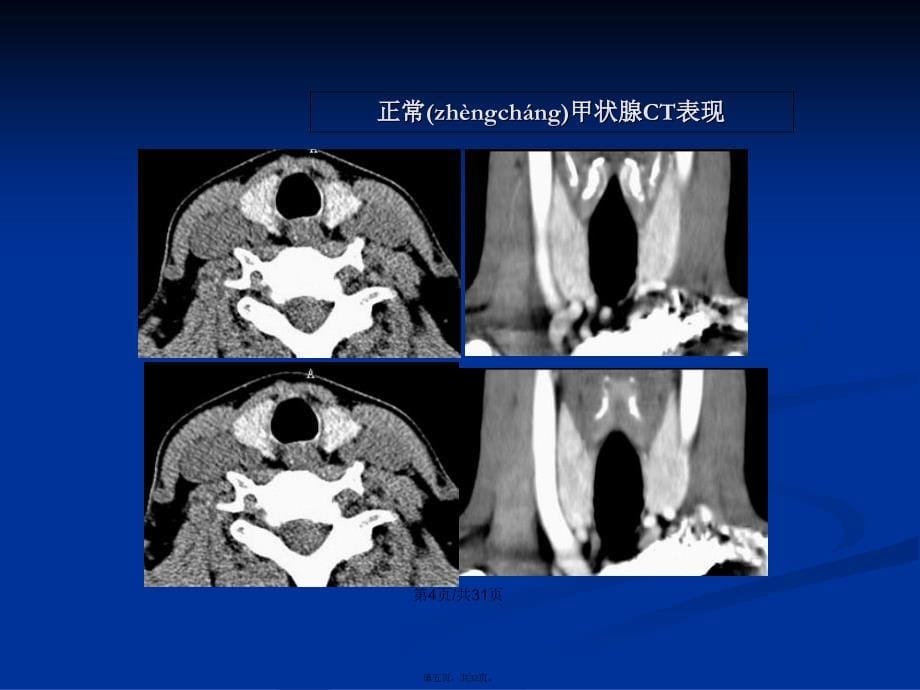 常见甲状腺疾病的CT诊断学习教案_第5页