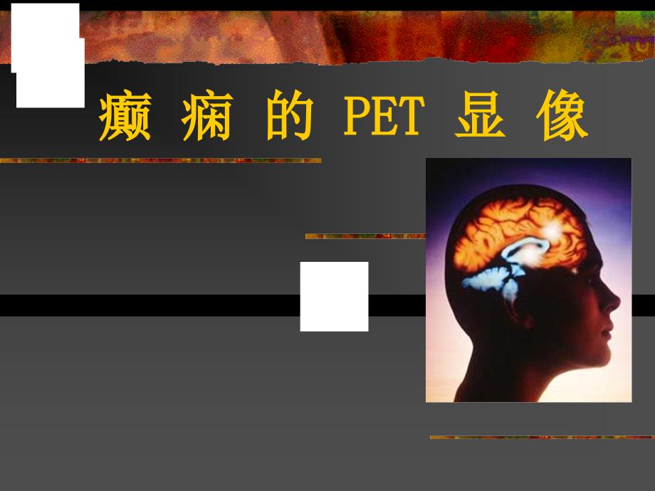 《癫痫的PET显像》PPT课件.ppt_第1页