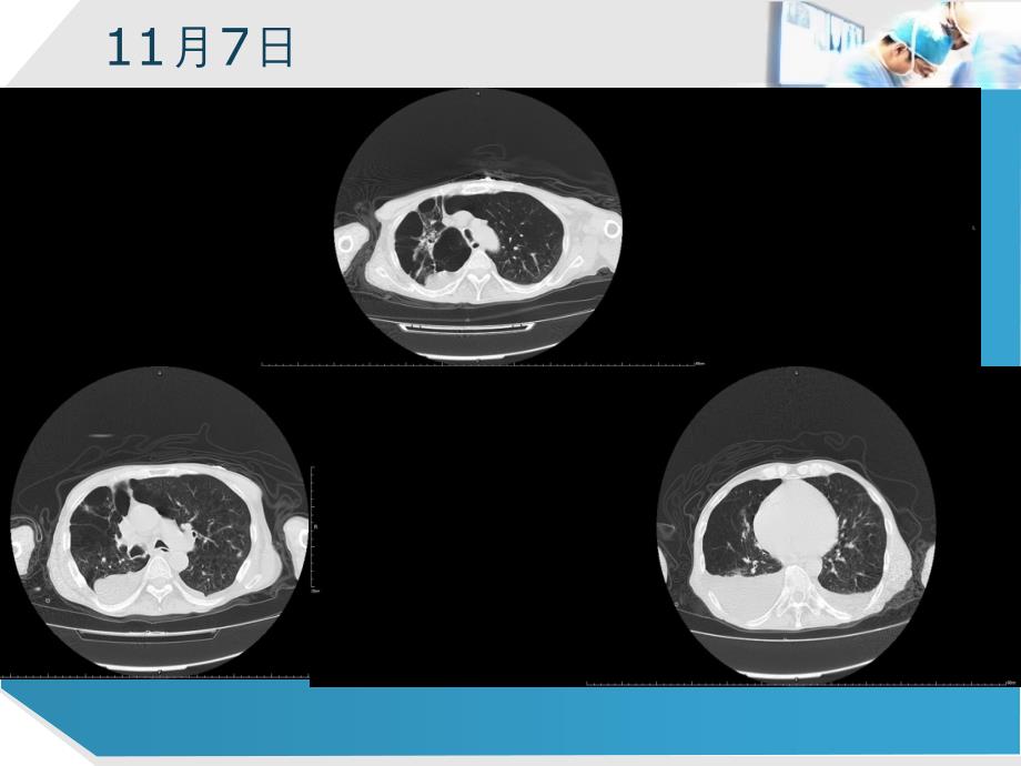 感染性心内膜炎并发急性肺栓塞一例-2015IE_第3页