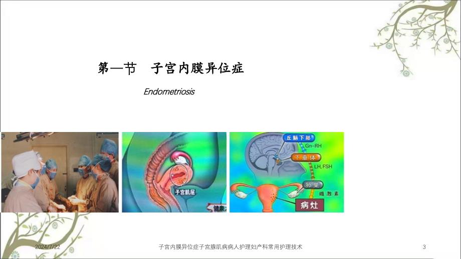 子宫内膜异位症子宫腺肌病病人护理妇产科常用护理技术_第3页