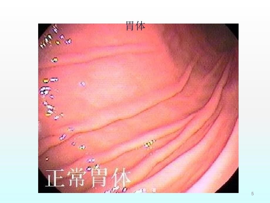 消化性溃疡内科学第8版2学时ppt课件_第5页