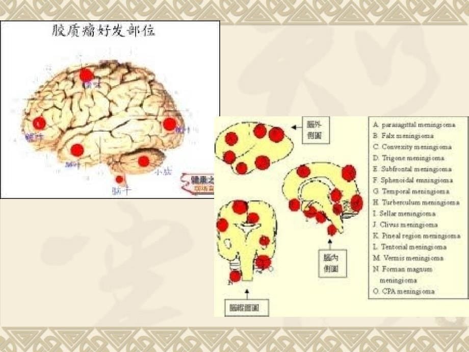 常见脑肿瘤的影像诊断_第5页