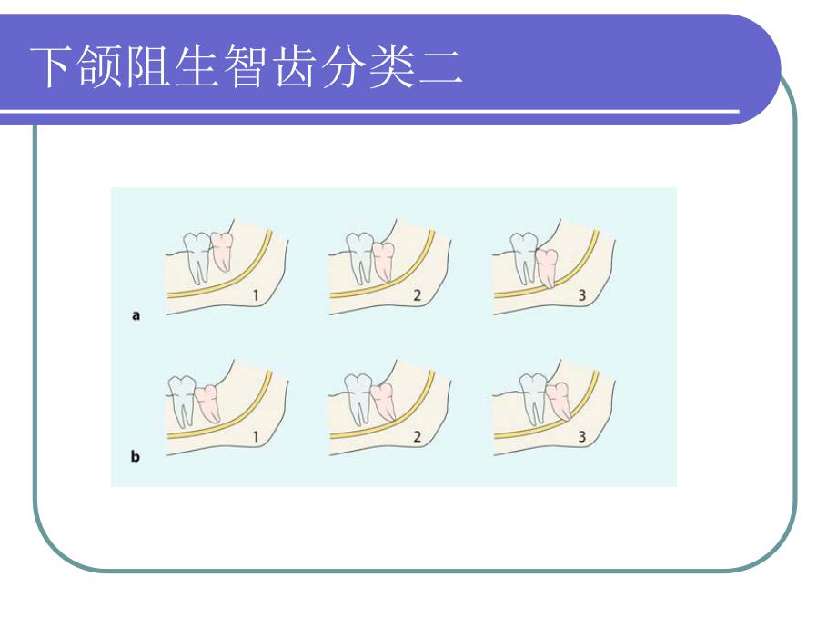 阻生牙的拔除_第4页