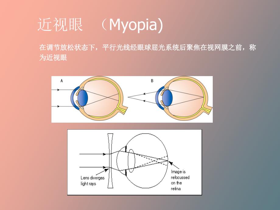 儿童近视防控八大要领褚仁远_第4页