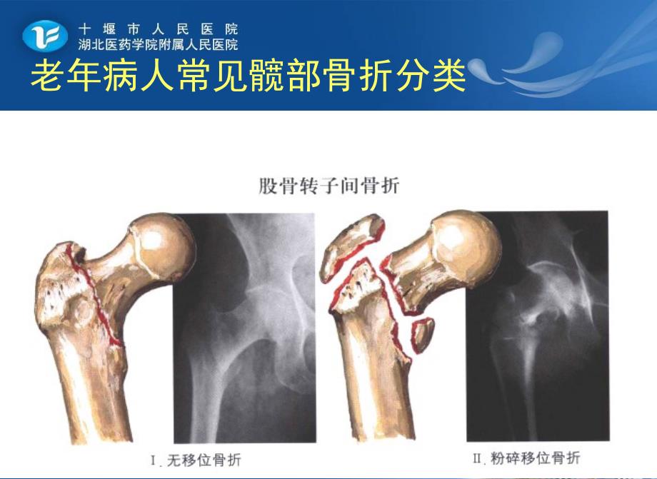 老年髋部骨折患者的护理_第4页