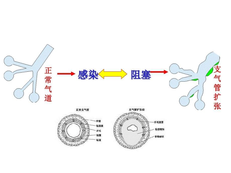 支气管扩张护理查房_第5页