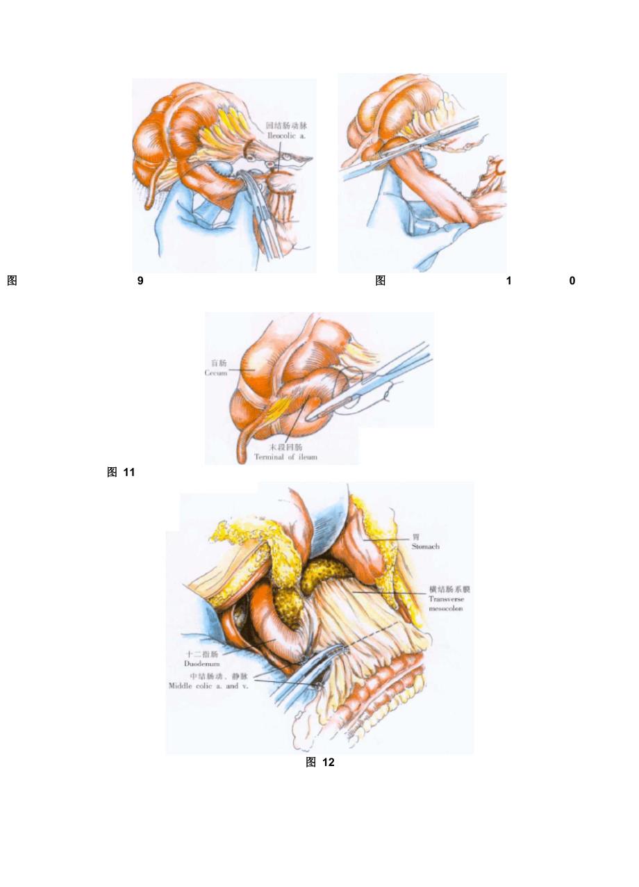 结肠全切除术_第5页