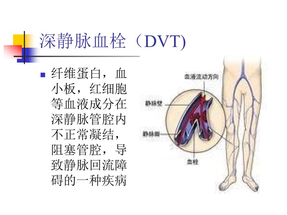 下肢深静脉血栓危险因素及预防ppt课件_第3页