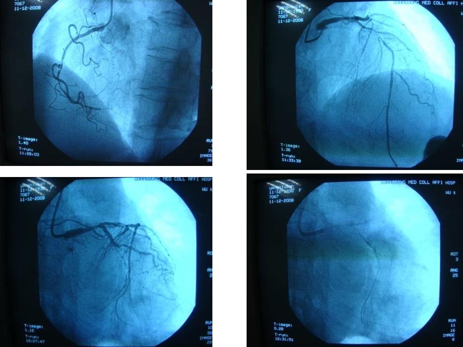 冠脉穿孔治病例解析_第2页