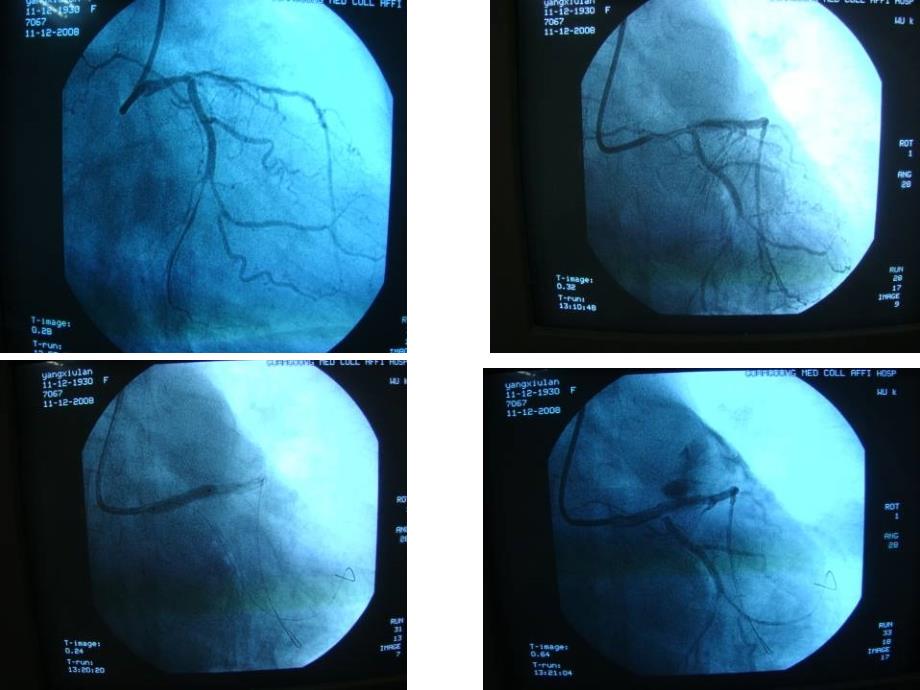 冠脉穿孔治病例解析_第3页
