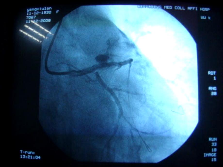 冠脉穿孔治病例解析_第4页
