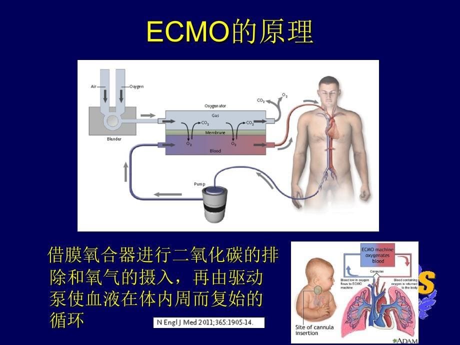 ECMO的治疗与进展_第5页