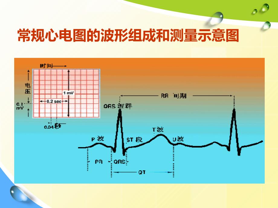 常见心脏疾病心电图表现_第4页