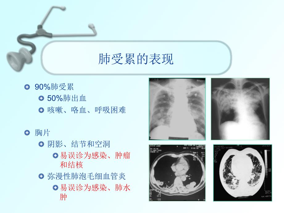 医学专题：ANCA相关性小血管炎的诊治_第4页