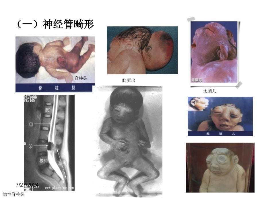 出生缺陷干预常见遗传病防治_第5页