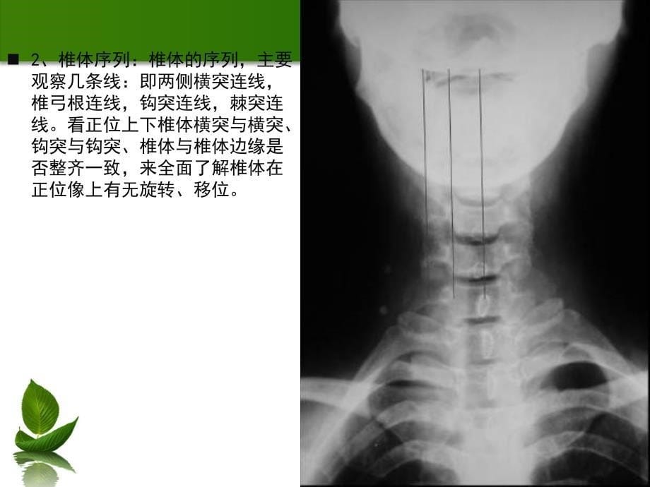 颈椎影像诊断PPT1250_第5页