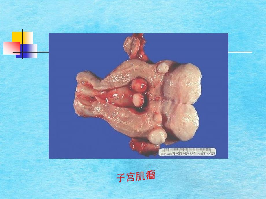 妇产科子宫肌瘤ppt课件_第3页