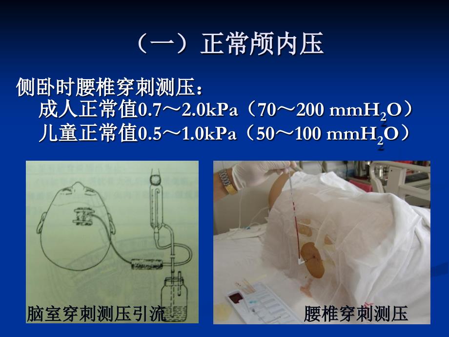 唐贝颅内压增高病人的护理精选文档_第2页