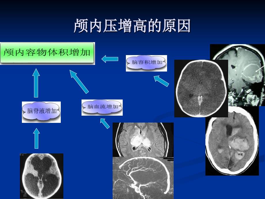 唐贝颅内压增高病人的护理精选文档_第4页